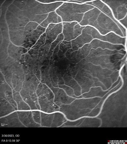 Macular ischemia left eye in type I diabetic (enlarged foveal avascular zone)
29 year old female with type I diabetes since age 5.  Left eye has enlarged FAZ with vision of 20/20 OD and 20/60 OS.  Both eyes have CSME.  The left eye did have focal laser
