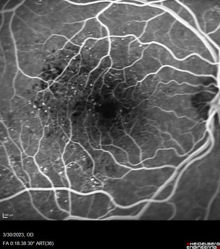 Macular ischemia left eye in type I diabetic (enlarged foveal avascular zone)
29 year old female with type I diabetes since age 5.  Left eye has enlarged FAZ with vision of 20/20 OD and 20/60 OS.  Both eyes have CSME.  The left eye did have focal laser
