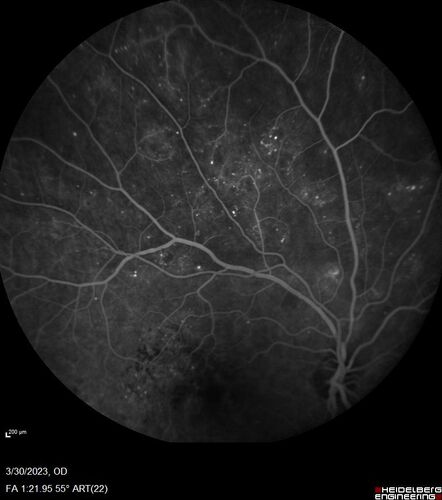 Macular ischemia left eye in type I diabetic (enlarged foveal avascular zone)
29 year old female with type I diabetes since age 5.  Left eye has enlarged FAZ with vision of 20/20 OD and 20/60 OS.  Both eyes have CSME.  The left eye did have focal laser
