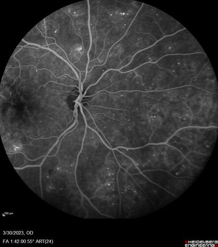 Macular ischemia left eye in type I diabetic (enlarged foveal avascular zone)
29 year old female with type I diabetes since age 5.  Left eye has enlarged FAZ with vision of 20/20 OD and 20/60 OS.  Both eyes have CSME.  The left eye did have focal laser
