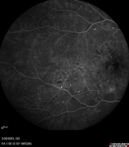 Macular ischemia left eye in type I diabetic (enlarged foveal avascular zone)
29 year old female with type I diabetes since age 5.  Left eye has enlarged FAZ with vision of 20/20 OD and 20/60 OS.  Both eyes have CSME.  The left eye did have focal laser
