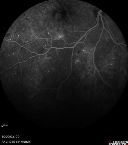 Macular ischemia left eye in type I diabetic (enlarged foveal avascular zone)
29 year old female with type I diabetes since age 5.  Left eye has enlarged FAZ with vision of 20/20 OD and 20/60 OS.  Both eyes have CSME.  The left eye did have focal laser
