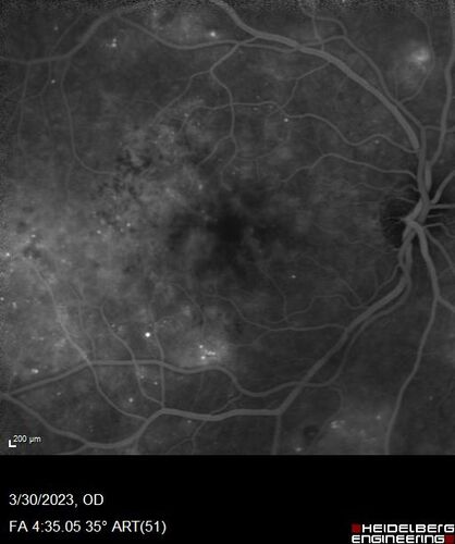 Macular ischemia left eye in type I diabetic (enlarged foveal avascular zone)
29 year old female with type I diabetes since age 5.  Left eye has enlarged FAZ with vision of 20/20 OD and 20/60 OS.  Both eyes have CSME.  The left eye did have focal laser

