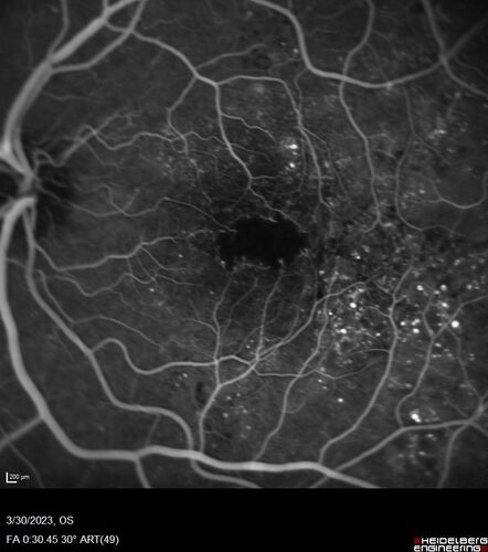 Macular ischemia left eye in type I diabetic (enlarged foveal avascular zone)
29 year old female with type I diabetes since age 5.  Left eye has enlarged FAZ with vision of 20/20 OD and 20/60 OS.  Both eyes have CSME.  The left eye did have focal laser
