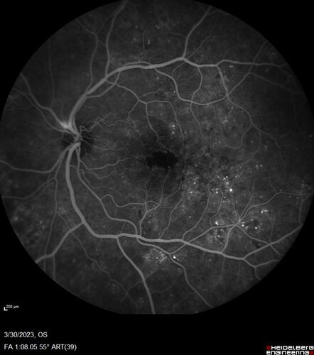 Macular ischemia left eye in type I diabetic (enlarged foveal avascular zone)
29 year old female with type I diabetes since age 5.  Left eye has enlarged FAZ with vision of 20/20 OD and 20/60 OS.  Both eyes have CSME.  The left eye did have focal laser
