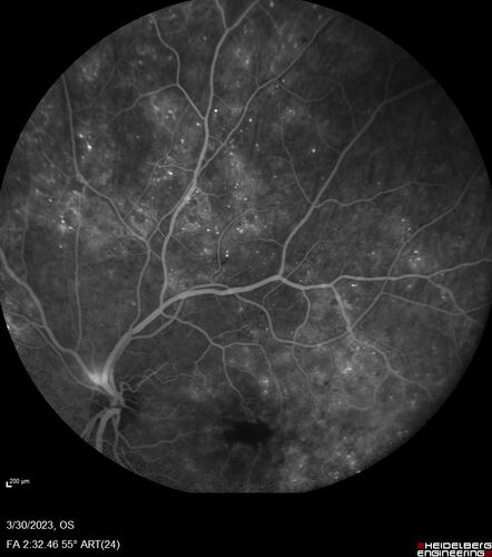 Macular ischemia left eye in type I diabetic (enlarged foveal avascular zone)
29 year old female with type I diabetes since age 5.  Left eye has enlarged FAZ with vision of 20/20 OD and 20/60 OS.  Both eyes have CSME.  The left eye did have focal laser
