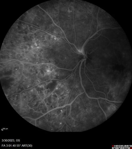 Macular ischemia left eye in type I diabetic (enlarged foveal avascular zone)
29 year old female with type I diabetes since age 5.  Left eye has enlarged FAZ with vision of 20/20 OD and 20/60 OS.  Both eyes have CSME.  The left eye did have focal laser
