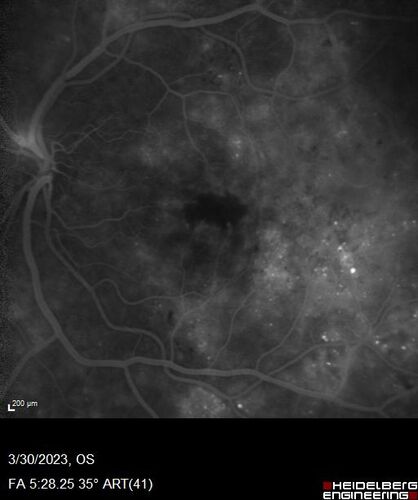 Macular ischemia left eye in type I diabetic (enlarged foveal avascular zone)
29 year old female with type I diabetes since age 5.  Left eye has enlarged FAZ with vision of 20/20 OD and 20/60 OS.  Both eyes have CSME.  The left eye did have focal laser
