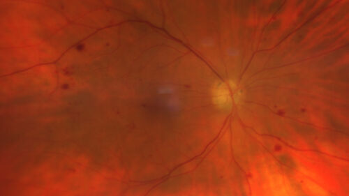 NPDR and Severe macular ischemia sudden vision loss
60 year old female with sudden vision loss OD 1 week ago.  VA 20/63, 20/200.  OCT-A and FA shows severe macular ischemia OU
