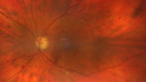 NPDR and Severe macular ischemia sudden vision loss
60 year old female with sudden vision loss OD 1 week ago.  VA 20/63, 20/200.  OCT-A and FA shows severe macular ischemia OU
