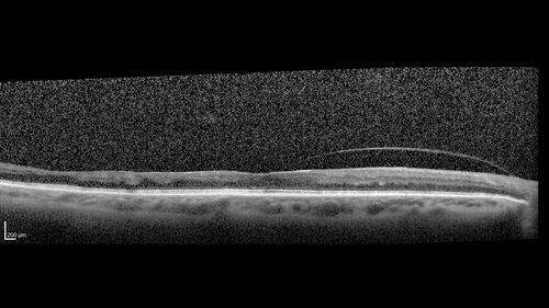 NPDR and Severe macular ischemia sudden vision loss
60 year old female with sudden vision loss OD 1 week ago.  VA 20/63, 20/200.  OCT-A and FA shows severe macular ischemia OU
