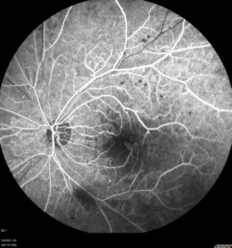 NPDR and Severe macular ischemia sudden vision loss
60 year old female with sudden vision loss OD 1 week ago.  VA 20/63, 20/200.  OCT-A and FA shows severe macular ischemia OU
