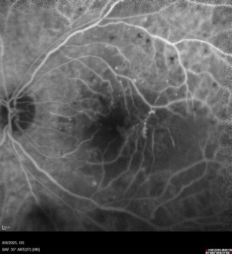 NPDR and Severe macular ischemia sudden vision loss
60 year old female with sudden vision loss OD 1 week ago.  VA 20/63, 20/200.  OCT-A and FA shows severe macular ischemia OU
