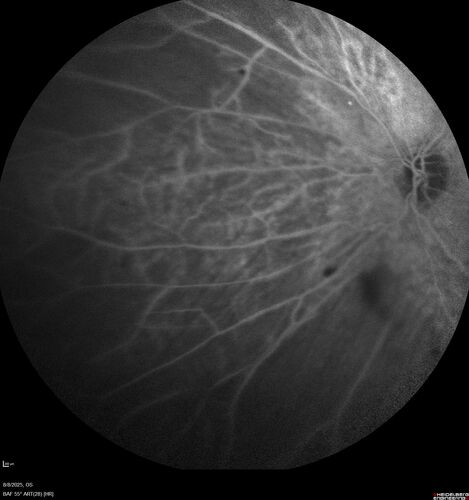 NPDR and Severe macular ischemia sudden vision loss
60 year old female with sudden vision loss OD 1 week ago.  VA 20/63, 20/200.  OCT-A and FA shows severe macular ischemia OU
