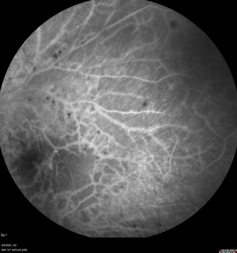 NPDR and Severe macular ischemia sudden vision loss
60 year old female with sudden vision loss OD 1 week ago.  VA 20/63, 20/200.  OCT-A and FA shows severe macular ischemia OU
