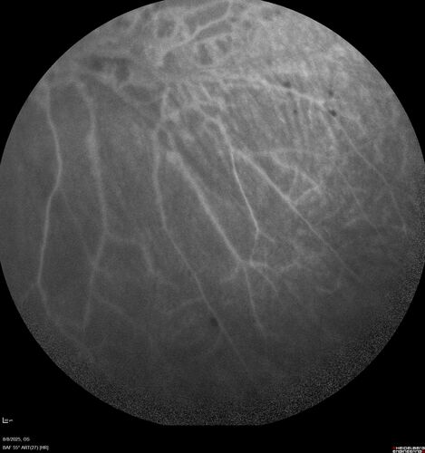 NPDR and Severe macular ischemia sudden vision loss
60 year old female with sudden vision loss OD 1 week ago.  VA 20/63, 20/200.  OCT-A and FA shows severe macular ischemia OU
