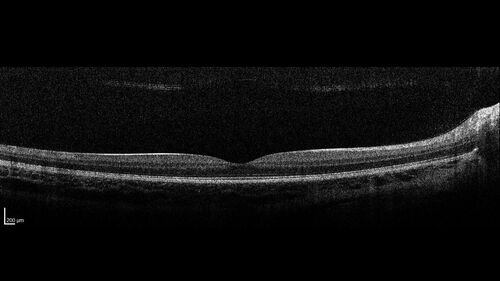 Optic Disc Drusen in a child (non Calcified)
Fluorescein angiography shows no leakage
