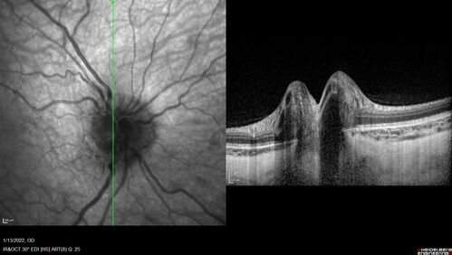 Optic Disc Drusen in a child (non Calcified)
Fluorescein angiography shows no leakage
