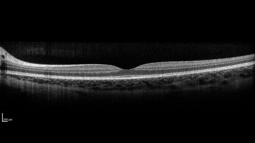 Optic Disc Drusen in a child (non Calcified)
Fluorescein angiography shows no leakage
