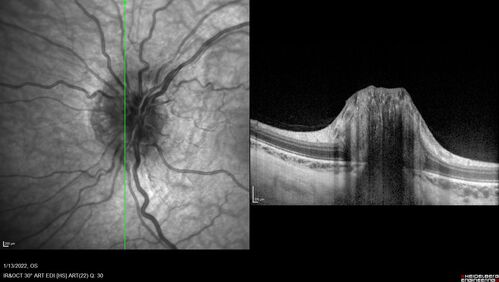 Optic Disc Drusen in a child (non Calcified)
Fluorescein angiography shows no leakage
