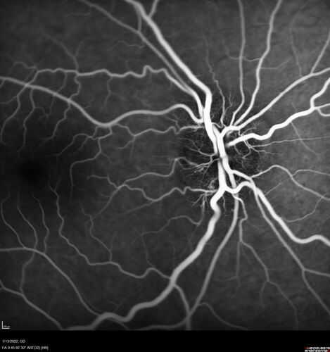 Optic Disc Drusen in a child (non Calcified)
Fluorescein angiography shows no leakage
