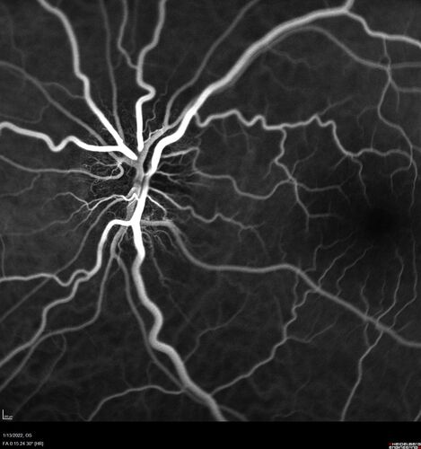 Optic Disc Drusen in a child (non Calcified)
Fluorescein angiography shows no leakage
