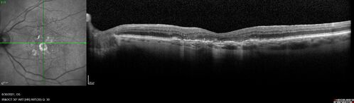 Pigment migration in dry age-related macular degeneration
80 year old female.  Dry AMD with GA in the left eye and pigment migration visible on OCT scan.
VA 20/40 OD, 20/160 OS
