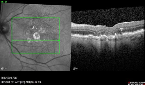 Pigment migration in dry age-related macular degeneration
80 year old female.  Dry AMD with GA in the left eye and pigment migration visible on OCT scan.
VA 20/40 OD, 20/160 OS
