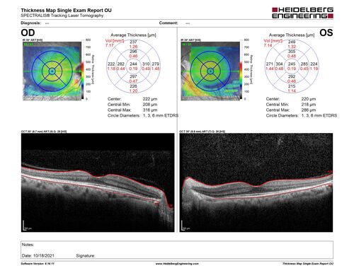 Sectoral Retinitis Pigmentosa - Asymptomatic
56-year-old female - The patient was in for an annual checkup because of her diabetes.Â  No visual complaints (no night vision trouble)
PMHx DM sine 2015, Asthma, Thyroid Disease, HTN
MEDS: Metformin, Levothyroxine, Lisinopril,, Inhaler
ROS Negative
VA OD: sc20/32-1 VA OS: sc20/32-1 
IOP: TP: OD:18 OS:17
293 Invitae genetic panel - negative
