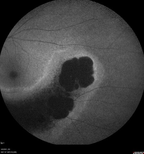 Sectoral Retinitis Pigmentosa - Asymptomatic
56-year-old female - The patient was in for an annual checkup because of her diabetes.Â  No visual complaints (no night vision trouble)
PMHx DM sine 2015, Asthma, Thyroid Disease, HTN
MEDS: Metformin, Levothyroxine, Lisinopril,, Inhaler
ROS Negative
VA OD: sc20/32-1 VA OS: sc20/32-1 
IOP: TP: OD:18 OS:17
293 Invitae genetic panel - negative
