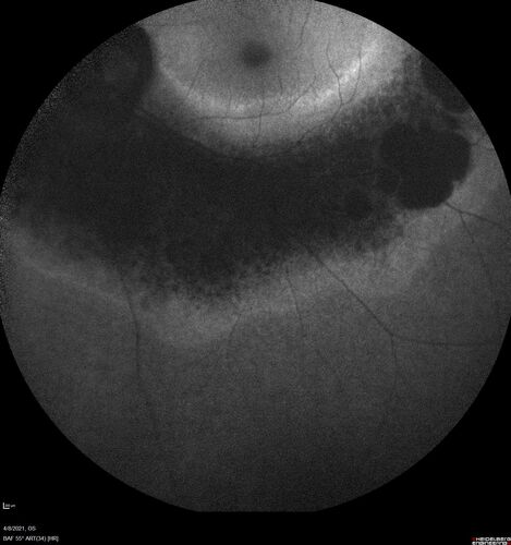 Sectoral Retinitis Pigmentosa - Asymptomatic
56-year-old female - The patient was in for an annual checkup because of her diabetes.Â  No visual complaints (no night vision trouble)
PMHx DM sine 2015, Asthma, Thyroid Disease, HTN
MEDS: Metformin, Levothyroxine, Lisinopril,, Inhaler
ROS Negative
VA OD: sc20/32-1 VA OS: sc20/32-1 
IOP: TP: OD:18 OS:17
293 Invitae genetic panel - negative
