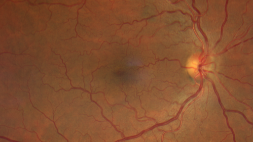 Alcohol Amblyopia - Toxic Optic Neuropathy
59 year old man HPI: CC: Blurred Vision OU. Duration of Problem: about 7 months. Location: central vision. Context Onset/Aggravation: Started after using Accutane for 1 month. Associated Symptoms: no flashes or floaters. 
HX TECH: EA
VA OD: sc20/100 PH20/80+1 Nsc20/400 PAM20/50+2
VA OS: sc20/100 PH20/80-2 NscJ16 PAM20/50+1
IOP 24 OD, 26 OS
B-12 and Folate were normal - Presumed ETOH amblyopia  - improved to 20/63,20/80 after one year of B-12 supplements
IOP: TP: OD:24 OS:26 Time:02:08 PM
