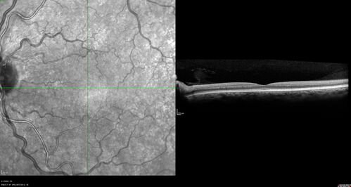 Alcohol Amblyopia - Toxic Optic Neuropathy
59 year old man HPI: CC: Blurred Vision OU. Duration of Problem: about 7 months. Location: central vision. Context Onset/Aggravation: Started after using Accutane for 1 month. Associated Symptoms: no flashes or floaters. 
HX TECH: EA
VA OD: sc20/100 PH20/80+1 Nsc20/400 PAM20/50+2
VA OS: sc20/100 PH20/80-2 NscJ16 PAM20/50+1
IOP 24 OD, 26 OS
B-12 and Folate were normal - Presumed ETOH amblyopia  - improved to 20/63,20/80 after one year of B-12 supplements
IOP: TP: OD:24 OS:26 Time:02:08 PM
