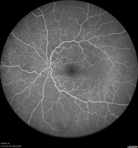 Alcohol Amblyopia - Toxic Optic Neuropathy
59 year old man HPI: CC: Blurred Vision OU. Duration of Problem: about 7 months. Location: central vision. Context Onset/Aggravation: Started after using Accutane for 1 month. Associated Symptoms: no flashes or floaters. 
HX TECH: EA
VA OD: sc20/100 PH20/80+1 Nsc20/400 PAM20/50+2
VA OS: sc20/100 PH20/80-2 NscJ16 PAM20/50+1
IOP 24 OD, 26 OS
B-12 and Folate were normal - Presumed ETOH amblyopia  - improved to 20/63,20/80 after one year of B-12 supplements
IOP: TP: OD:24 OS:26 Time:02:08 PM
