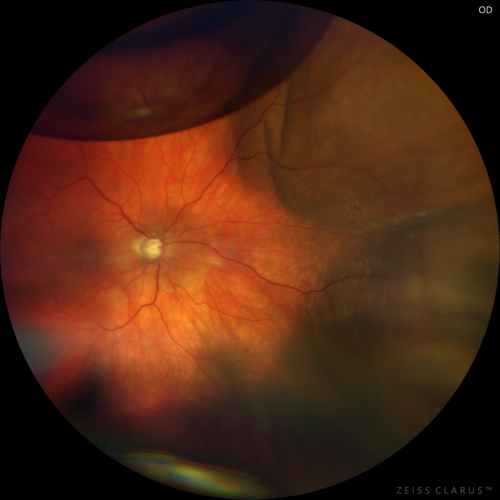 Choroidal Effusion One Day following macular pucker surgery
70 year old female one day following macular pucker surgery.  Her VA was 20/100, IOP was 12.  The air bubble was to pressurize the eye at the conclusion of the 25 gauge vitrectomy.  The choroidal effusion is in the periphery.
