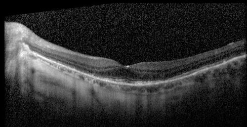 Elmiron (pentasosan polysulfate) Macular Toxicity
77 year old female who had been on Elmiron for 20 years  and stopped it 2 years ago
