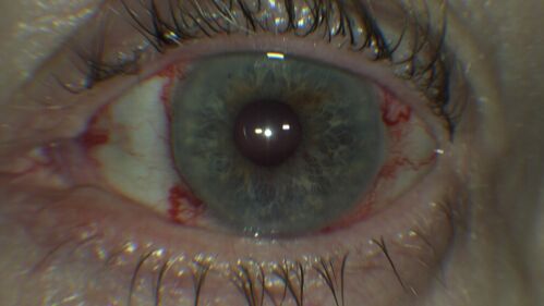 Elevated Episcleral Venous Pressure and Retinal Hemorrhages in both eyes
78 year old female with chronic red eye.   The eyes are red all the time now.  She is on Xeralto because of a history of blood clots in her lungs (2005 about).  She has not had problems since.  She has had floaters for many years.  Ever since her eyes got funny she sees more floaters in both eyes.  She had a brain scan over 6 months ago which was OK.  She also had double vision when this first started which went away.  She could not drive for a few months.  
VA OD: Dcc20/32-1 
VA OS: Dcc20/125 
IOP: TP: OD:17 OS:16
Neuroimaging did not show a CC fistula
