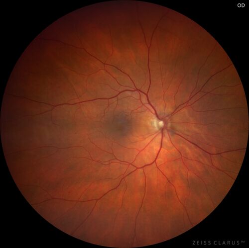 Elevated Episcleral Venous Pressure and Retinal Hemorrhages in both eyes
78 year old female with chronic red eye.   The eyes are red all the time now.  She is on Xeralto because of a history of blood clots in her lungs (2005 about).  She has not had problems since.  She has had floaters for many years.  Ever since her eyes got funny she sees more floaters in both eyes.  She had a brain scan over 6 months ago which was OK.  She also had double vision when this first started which went away.  She could not drive for a few months.  
VA OD: Dcc20/32-1 
VA OS: Dcc20/125 
IOP: TP: OD:17 OS:16
Neuroimaging did not show a CC fistula
