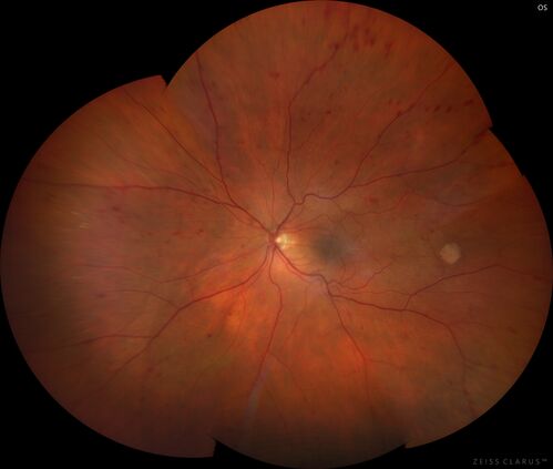 Elevated Episcleral Venous Pressure and Retinal Hemorrhages in both eyes
78 year old female with chronic red eye.   The eyes are red all the time now.  She is on Xeralto because of a history of blood clots in her lungs (2005 about).  She has not had problems since.  She has had floaters for many years.  Ever since her eyes got funny she sees more floaters in both eyes.  She had a brain scan over 6 months ago which was OK.  She also had double vision when this first started which went away.  She could not drive for a few months.  
VA OD: Dcc20/32-1 
VA OS: Dcc20/125 
IOP: TP: OD:17 OS:16
Neuroimaging did not show a CC fistula
