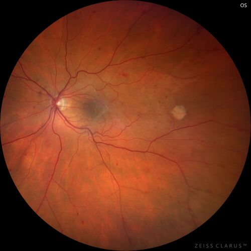 Elevated Episcleral Venous Pressure and Retinal Hemorrhages in both eyes
78 year old female with chronic red eye.   The eyes are red all the time now.  She is on Xeralto because of a history of blood clots in her lungs (2005 about).  She has not had problems since.  She has had floaters for many years.  Ever since her eyes got funny she sees more floaters in both eyes.  She had a brain scan over 6 months ago which was OK.  She also had double vision when this first started which went away.  She could not drive for a few months.  
VA OD: Dcc20/32-1 
VA OS: Dcc20/125 
IOP: TP: OD:17 OS:16
Neuroimaging did not show a CC fistula
