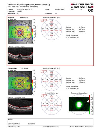 Elevated Episcleral Venous Pressure and Retinal Hemorrhages in both eyes
78 year old female with chronic red eye.   The eyes are red all the time now.  She is on Xeralto because of a history of blood clots in her lungs (2005 about).  She has not had problems since.  She has had floaters for many years.  Ever since her eyes got funny she sees more floaters in both eyes.  She had a brain scan over 6 months ago which was OK.  She also had double vision when this first started which went away.  She could not drive for a few months.  
VA OD: Dcc20/32-1 
VA OS: Dcc20/125 
IOP: TP: OD:17 OS:16
Neuroimaging did not show a CC fistula
