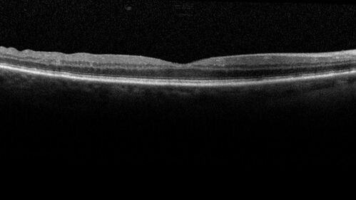 Elevated Episcleral Venous Pressure and Retinal Hemorrhages in both eyes
78 year old female with chronic red eye.   The eyes are red all the time now.  She is on Xeralto because of a history of blood clots in her lungs (2005 about).  She has not had problems since.  She has had floaters for many years.  Ever since her eyes got funny she sees more floaters in both eyes.  She had a brain scan over 6 months ago which was OK.  She also had double vision when this first started which went away.  She could not drive for a few months.  
VA OD: Dcc20/32-1 
VA OS: Dcc20/125 
IOP: TP: OD:17 OS:16
Neuroimaging did not show a CC fistula
