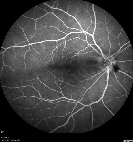 Elevated Episcleral Venous Pressure and Retinal Hemorrhages in both eyes
78 year old female with chronic red eye.   The eyes are red all the time now.  She is on Xeralto because of a history of blood clots in her lungs (2005 about).  She has not had problems since.  She has had floaters for many years.  Ever since her eyes got funny she sees more floaters in both eyes.  She had a brain scan over 6 months ago which was OK.  She also had double vision when this first started which went away.  She could not drive for a few months.  
VA OD: Dcc20/32-1 
VA OS: Dcc20/125 
IOP: TP: OD:17 OS:16
Neuroimaging did not show a CC fistula
