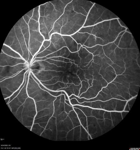 Elevated Episcleral Venous Pressure and Retinal Hemorrhages in both eyes
78 year old female with chronic red eye.   The eyes are red all the time now.  She is on Xeralto because of a history of blood clots in her lungs (2005 about).  She has not had problems since.  She has had floaters for many years.  Ever since her eyes got funny she sees more floaters in both eyes.  She had a brain scan over 6 months ago which was OK.  She also had double vision when this first started which went away.  She could not drive for a few months.  
VA OD: Dcc20/32-1 
VA OS: Dcc20/125 
IOP: TP: OD:17 OS:16
Neuroimaging did not show a CC fistula

