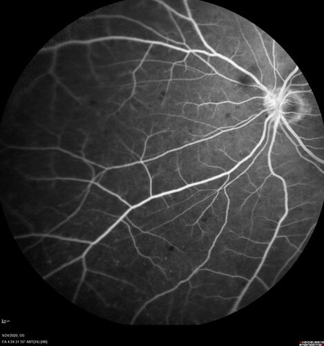 Elevated Episcleral Venous Pressure and Retinal Hemorrhages in both eyes
78 year old female with chronic red eye.   The eyes are red all the time now.  She is on Xeralto because of a history of blood clots in her lungs (2005 about).  She has not had problems since.  She has had floaters for many years.  Ever since her eyes got funny she sees more floaters in both eyes.  She had a brain scan over 6 months ago which was OK.  She also had double vision when this first started which went away.  She could not drive for a few months.  
VA OD: Dcc20/32-1 
VA OS: Dcc20/125 
IOP: TP: OD:17 OS:16
Neuroimaging did not show a CC fistula
