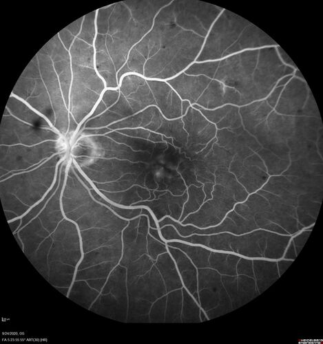 Elevated Episcleral Venous Pressure and Retinal Hemorrhages in both eyes
78 year old female with chronic red eye.   The eyes are red all the time now.  She is on Xeralto because of a history of blood clots in her lungs (2005 about).  She has not had problems since.  She has had floaters for many years.  Ever since her eyes got funny she sees more floaters in both eyes.  She had a brain scan over 6 months ago which was OK.  She also had double vision when this first started which went away.  She could not drive for a few months.  
VA OD: Dcc20/32-1 
VA OS: Dcc20/125 
IOP: TP: OD:17 OS:16
Neuroimaging did not show a CC fistula
