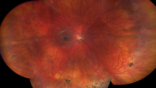 FEVR and Loeys-Deitz Syndrome - TGFBR gene defect
15 year old boy with Loeys-Deitz Syndrome. And TGFBR gene positivity.  At age 11 he had aortic root surgery.  VA 20/25 OU.  Anterior segment normal.  Retina shows findings consistent with mild familial exudative vitreoretinopathy
