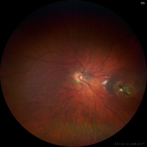 Familial Exudative Vitreoretinopathy - FEVR - Stage 1-b both eyes
She was born at term.Â Â Â No family history of eye disease.
VA OD: Dcc20/25, VA OS: Dcc20/200+1 Ncc20/400
Anterior segment normal â€“ clear lenses
