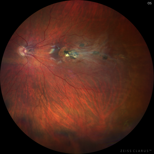 Familial Exudative Vitreoretinopathy - FEVR - Stage 1-b both eyes
She was born at term.Â Â Â No family history of eye disease.
VA OD: Dcc20/25, VA OS: Dcc20/200+1 Ncc20/400
Anterior segment normal â€“ clear lenses
