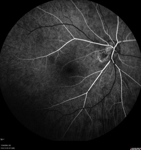 Familial Exudative Vitreoretinopathy - FEVR - Stage 1-b both eyes
She was born at term.Â Â Â No family history of eye disease.
VA OD: Dcc20/25, VA OS: Dcc20/200+1 Ncc20/400
Anterior segment normal â€“ clear lenses
